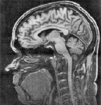 Picture of a MRI scan of a head.